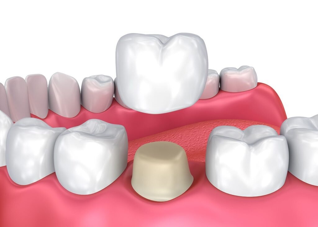 dental crown and bridges