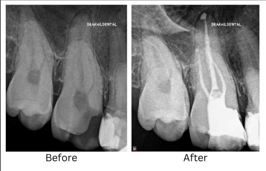 root canal treatment