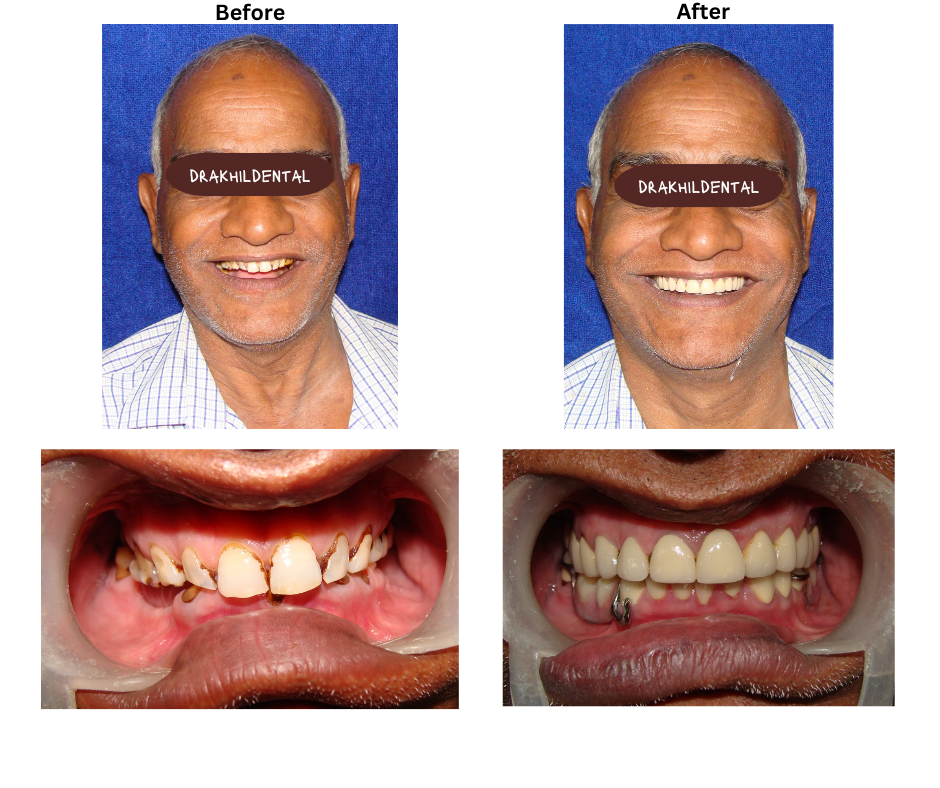 Full Mouth Rehabilitation