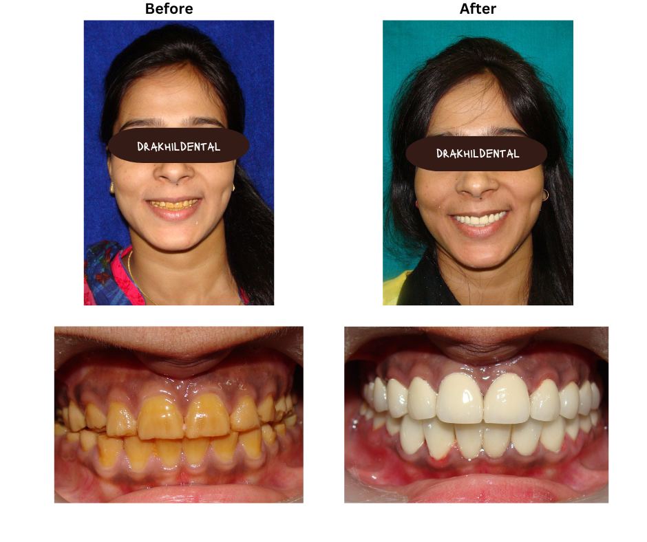 Full Mouth Rehabilitation